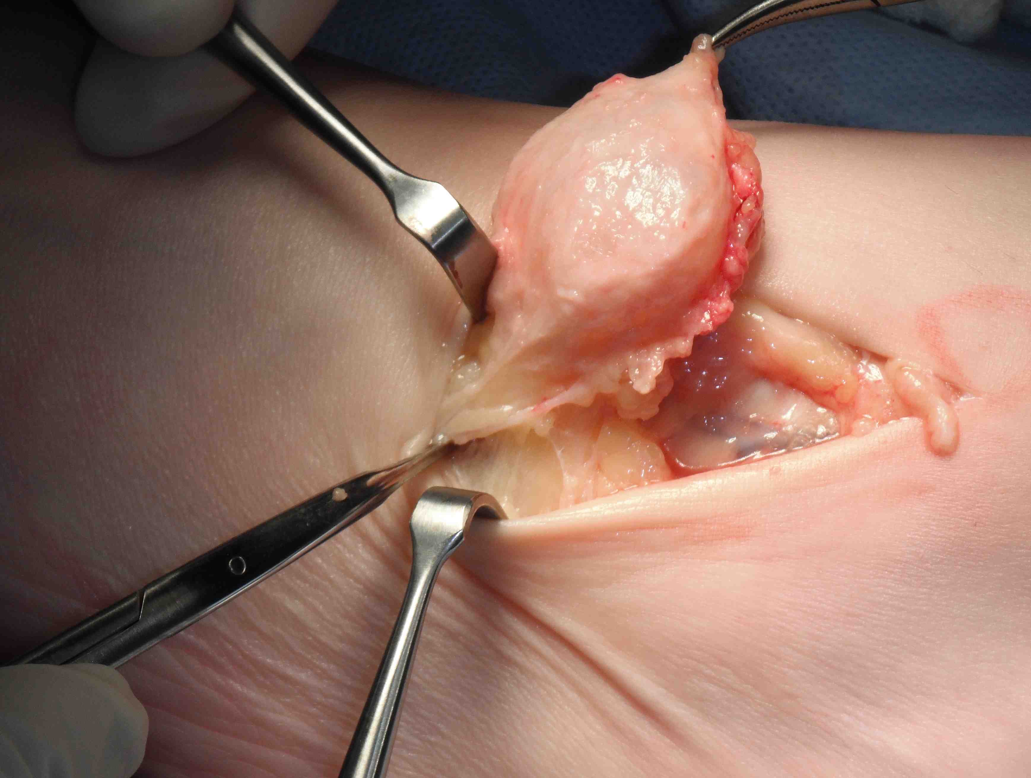 Foot Ganglion Excision